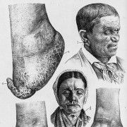 Gravures anciennes - Dermatologie