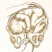 Gravures anciennes - Obstétrique